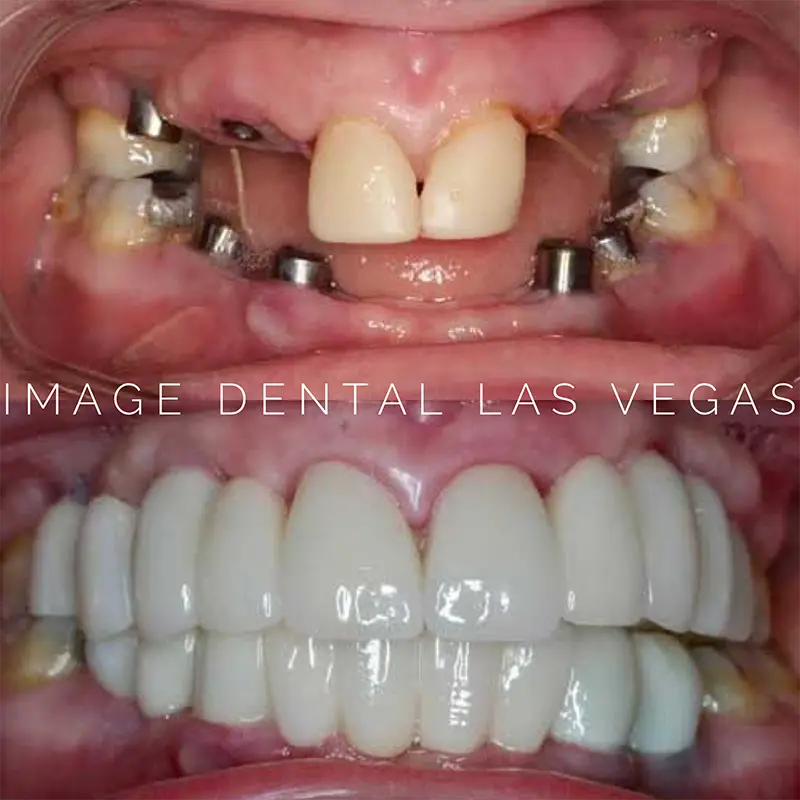 Free Tooth Extraction Las Vegas / Las Vegas Dental Office Offers ...